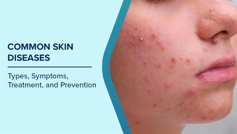Skin Diseases and Common Skin Issue and Treatment